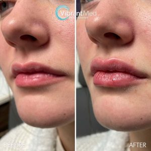 Lip Filler Medical Spa in Louisville