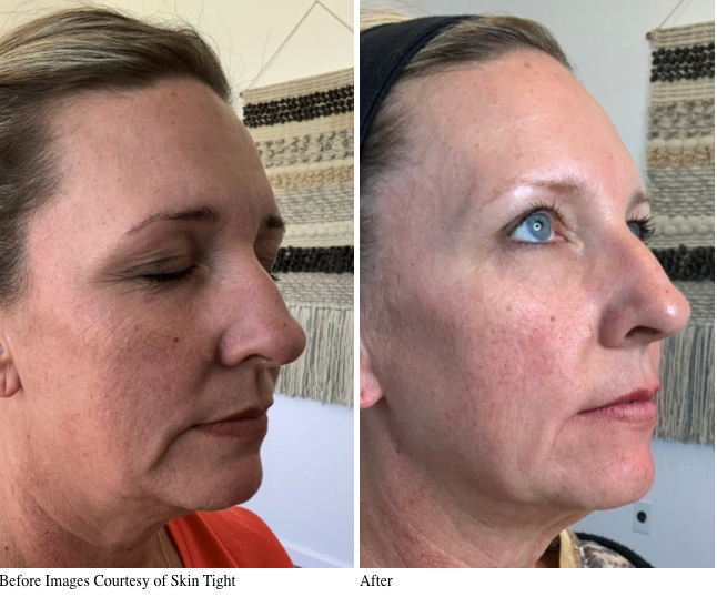 Microneedling Louisville KY