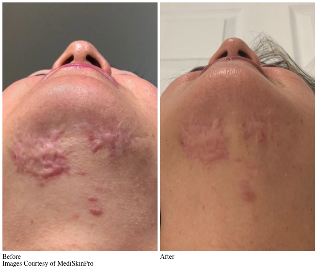 Microneedling Louisville Medical Spa