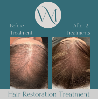 Hair Restoration Treatments Louisville