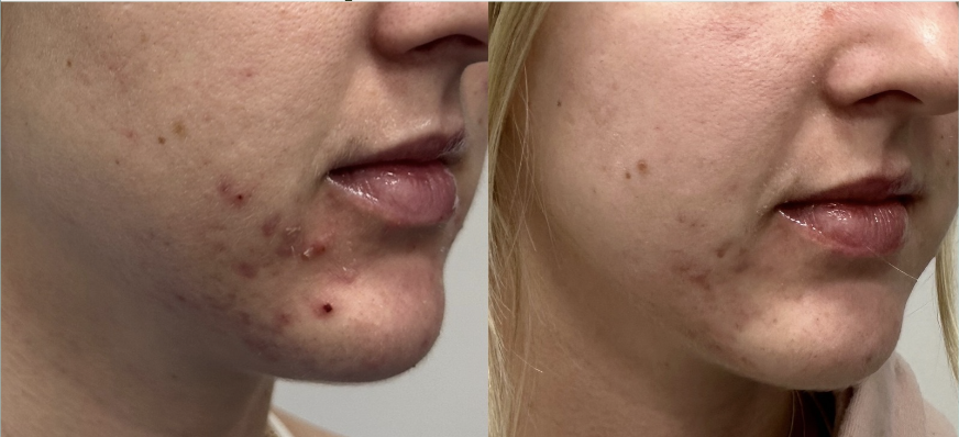 Before Acne Treatment at Louisville Medical Spa